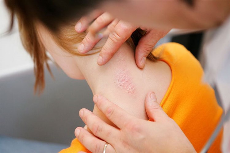 SEDEF HASTALIĞI NASIL GEÇER